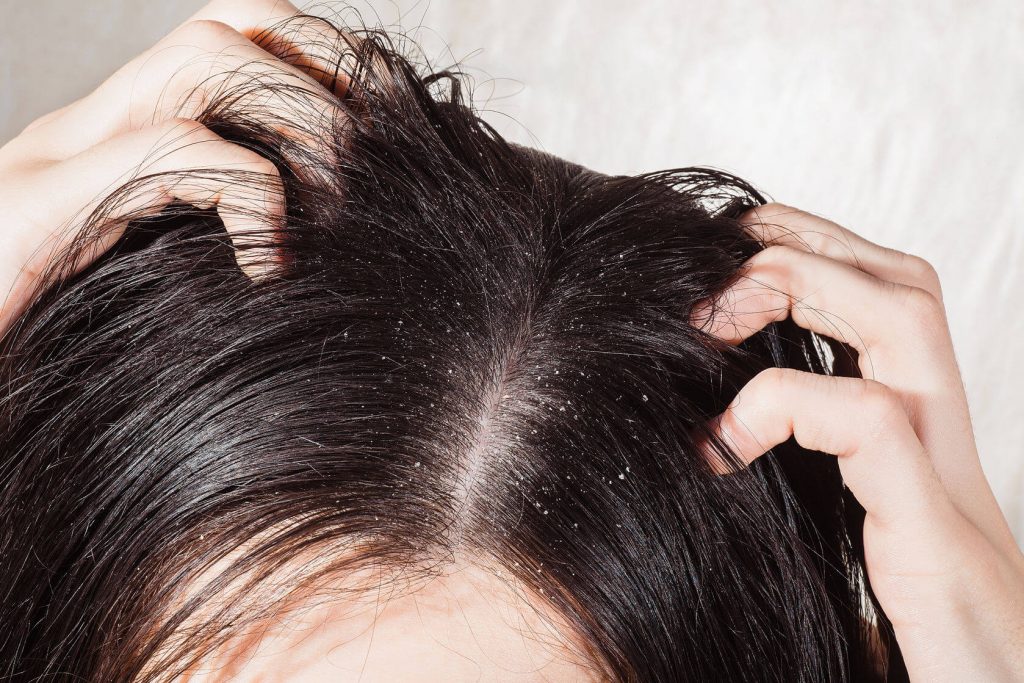 Dandruff Treatment